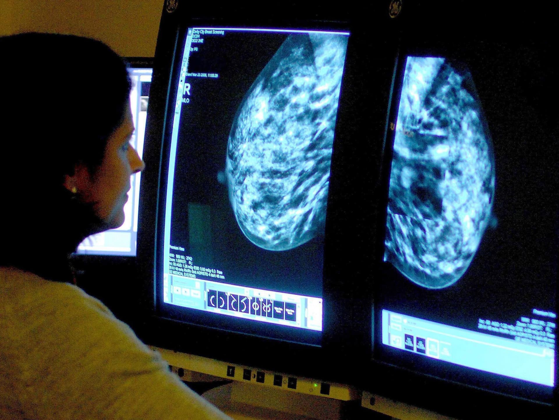 20 Millionen neue Diagnosen: Zahl der Krebserkrankungen steigt weltweit