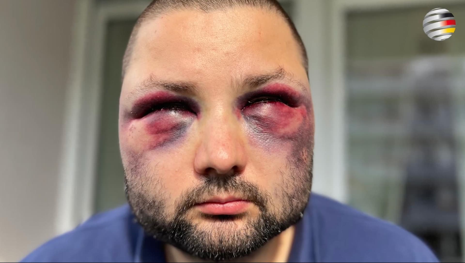 „Du bist doch der von den Plakaten…“: Prügel-Überfall auf AfD-Politiker in Augsburg