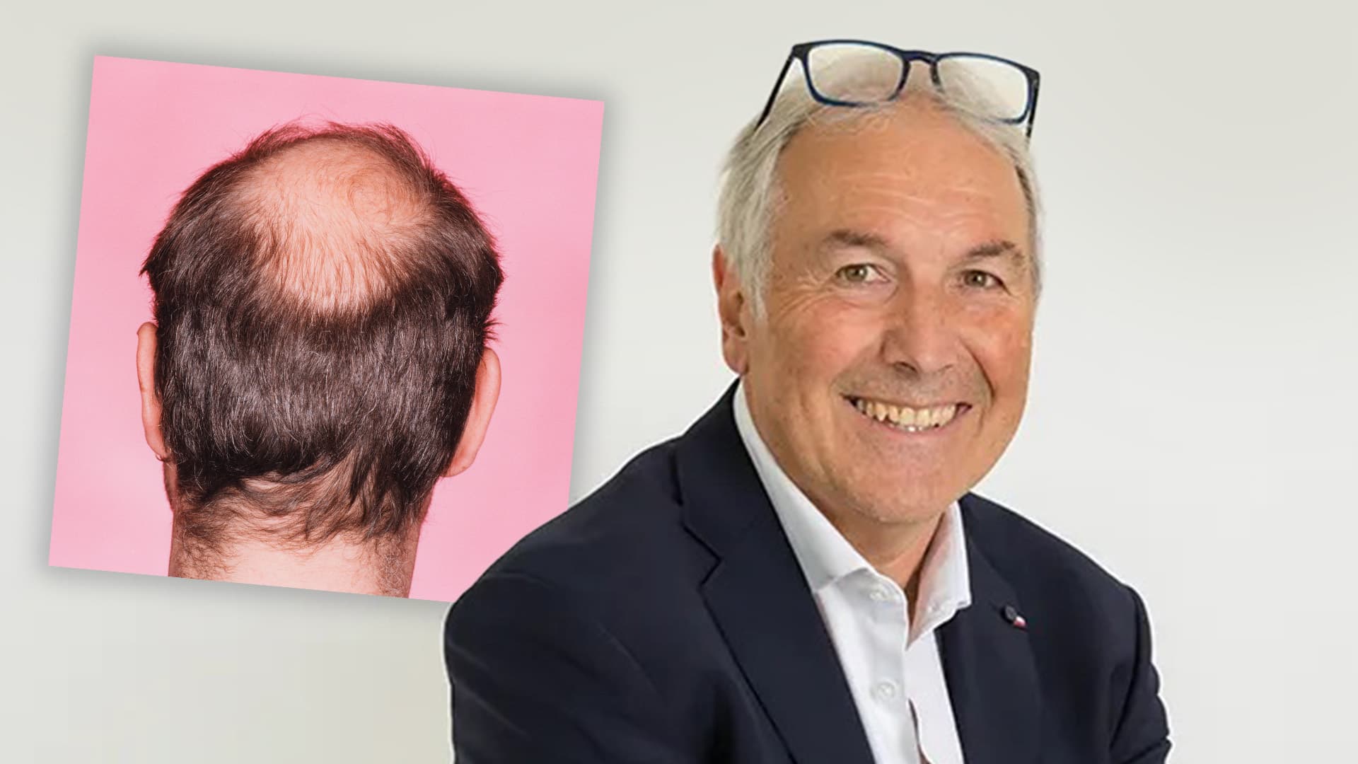 Wirkstoff durch Zufall entdeckt: Immunologe findet Mittel gegen Haarausfall