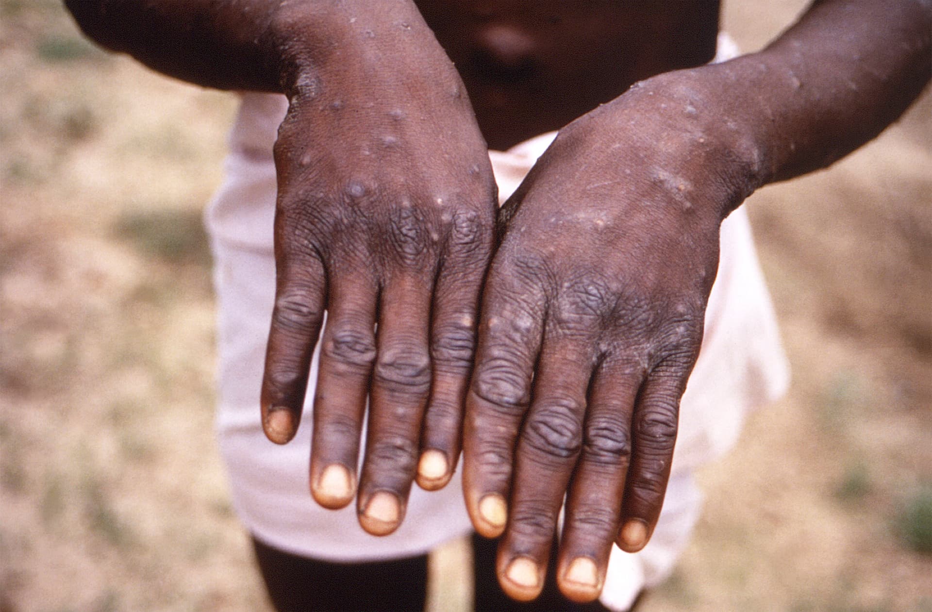 Wegen Ausbreitung von Affenpocken (Mpox): WHO ruft weltweite Notlage aus