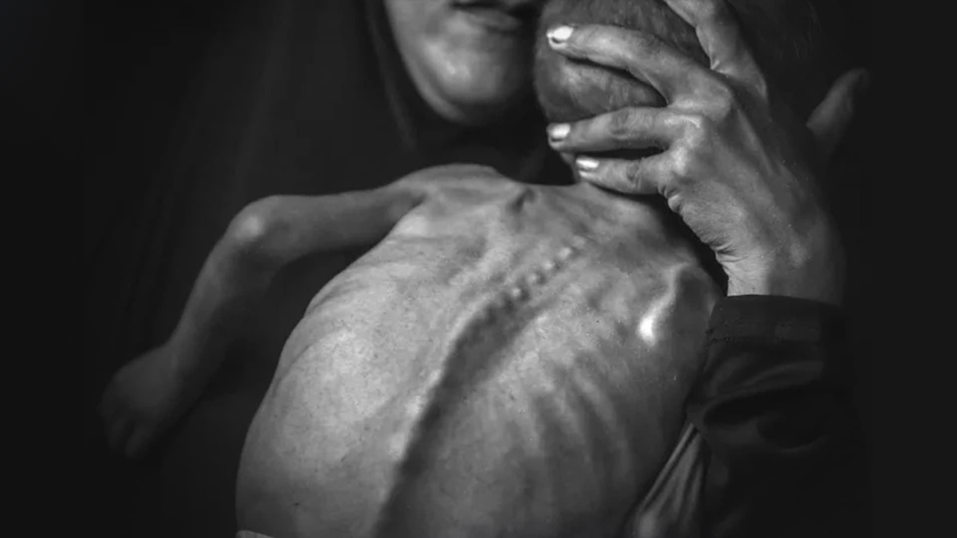 Krankes palästinensisches Kind: Journalistenverband kritisiert Propaganda-Fotos, die nicht auf „Hungersnot in Gaza zurückzuführen“ sind